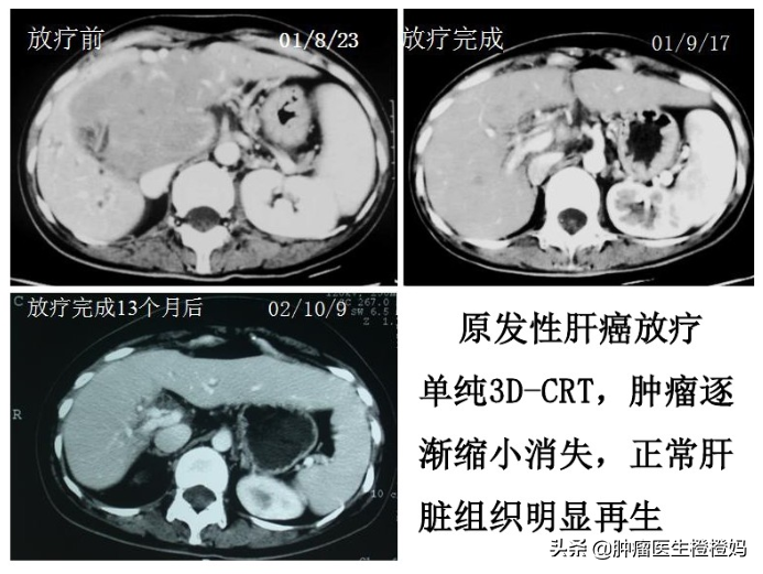 腹痛腹胀食欲差，检查发现竟是癌症晚期，医生：这样做可早诊早治