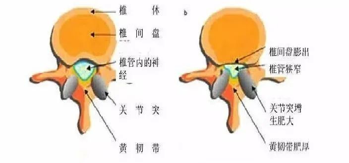 腰痛反复发作的原因是什么？