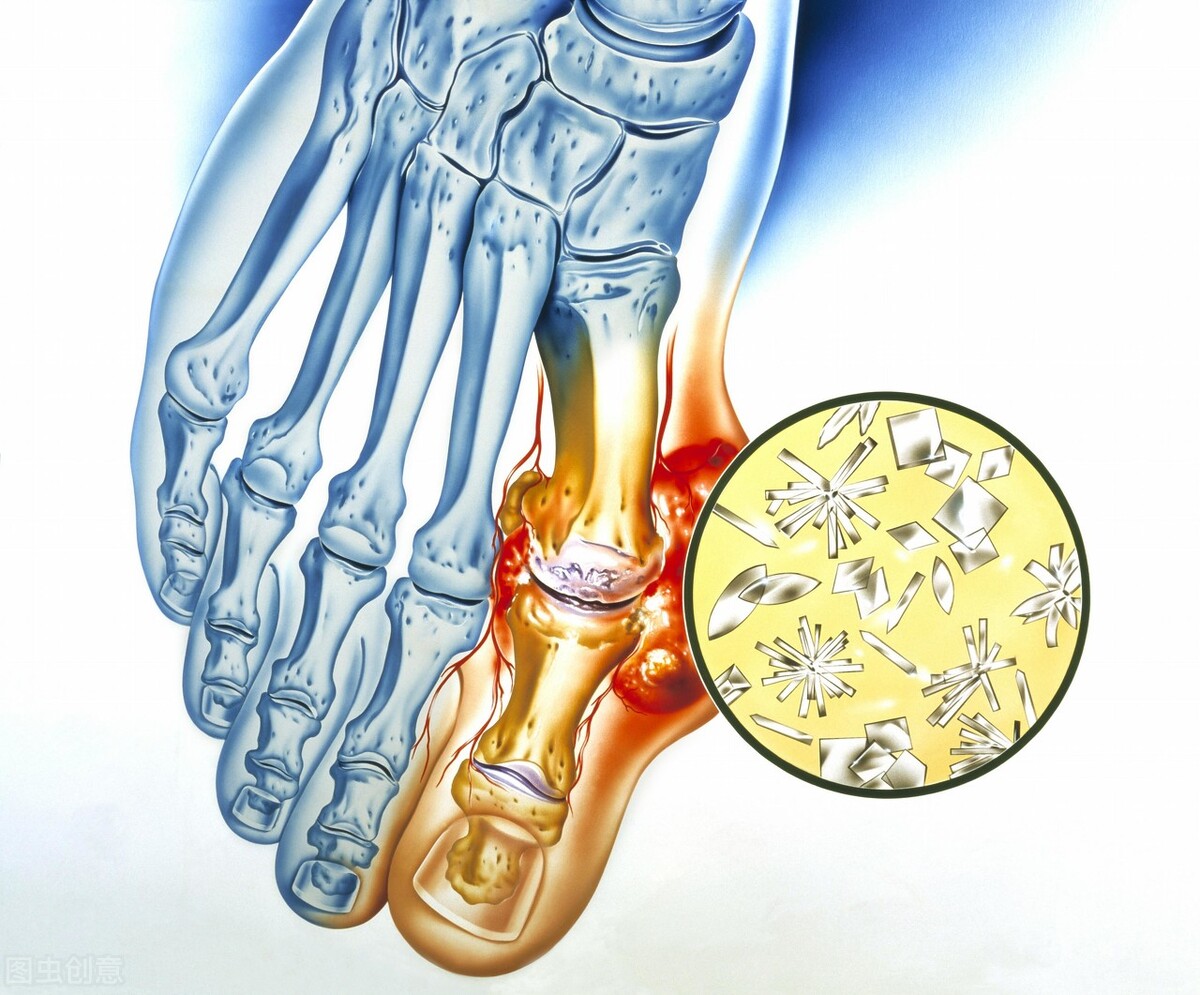 尿酸高不等于痛风，但要警惕并发症，5个方法远离高尿酸