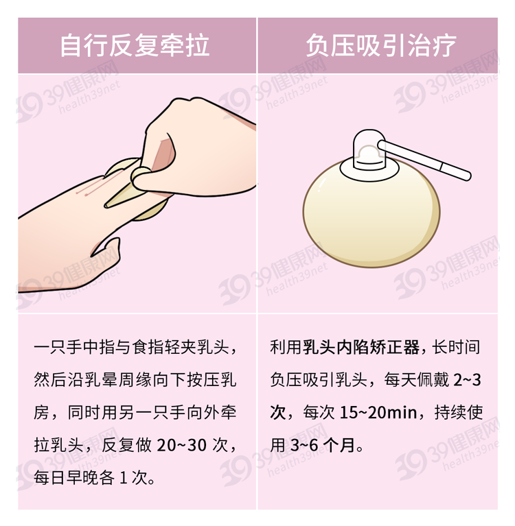 什么是“乳头内陷”？要怎么治疗？2个原因，可能让它暂时消失