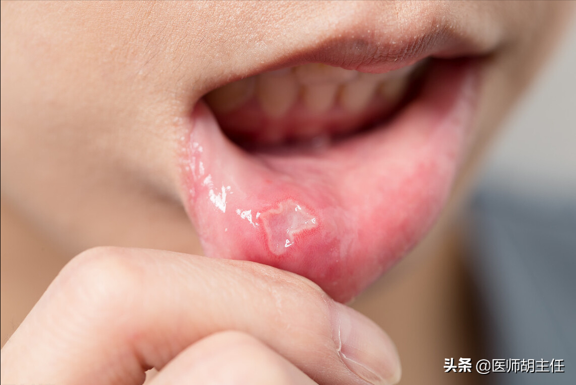 有一种痛，叫口腔溃疡！医生提醒：牢记这几招，促进口腔溃疡愈合