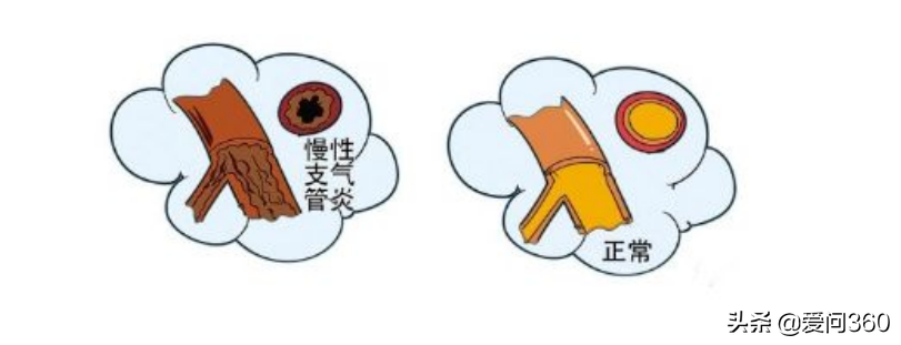有这几个表现说明是慢性支气管炎，注意这些问题，不适感全部消除