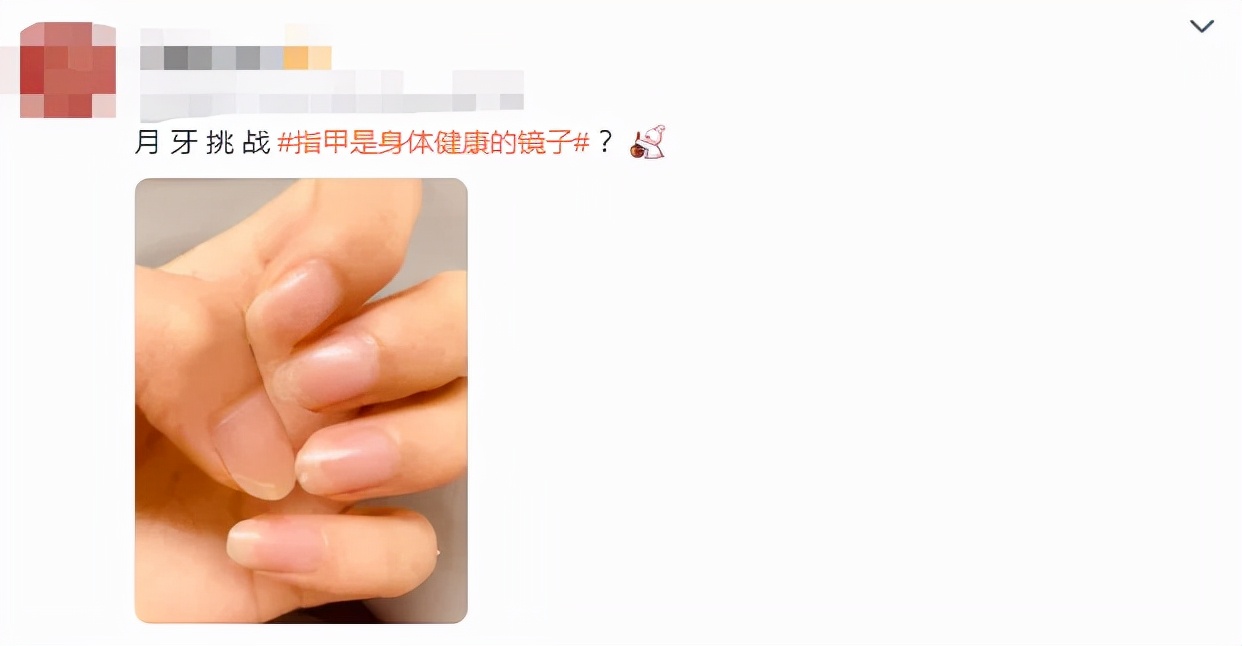 指甲长白点、有竖纹，是身体出问题了？一次说清指甲的这些问题