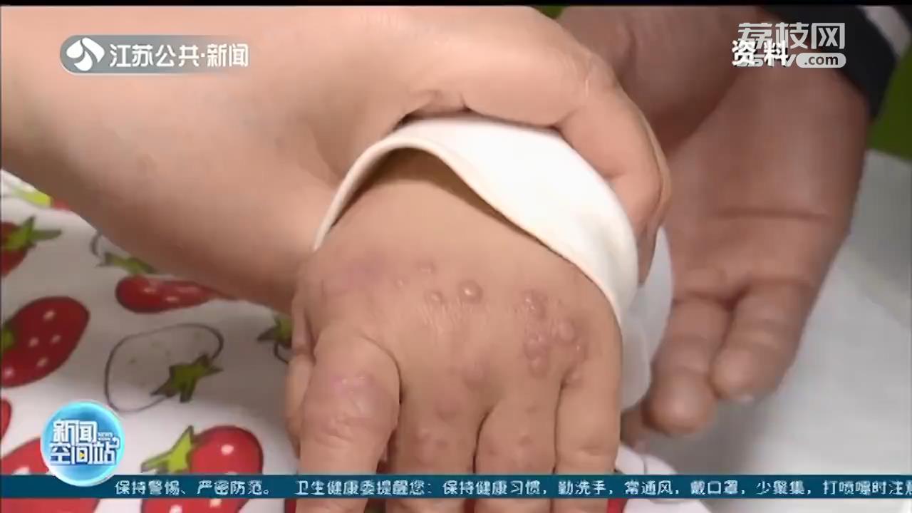 南京疾控提醒：近期手足口病多发 5岁以下儿童易感