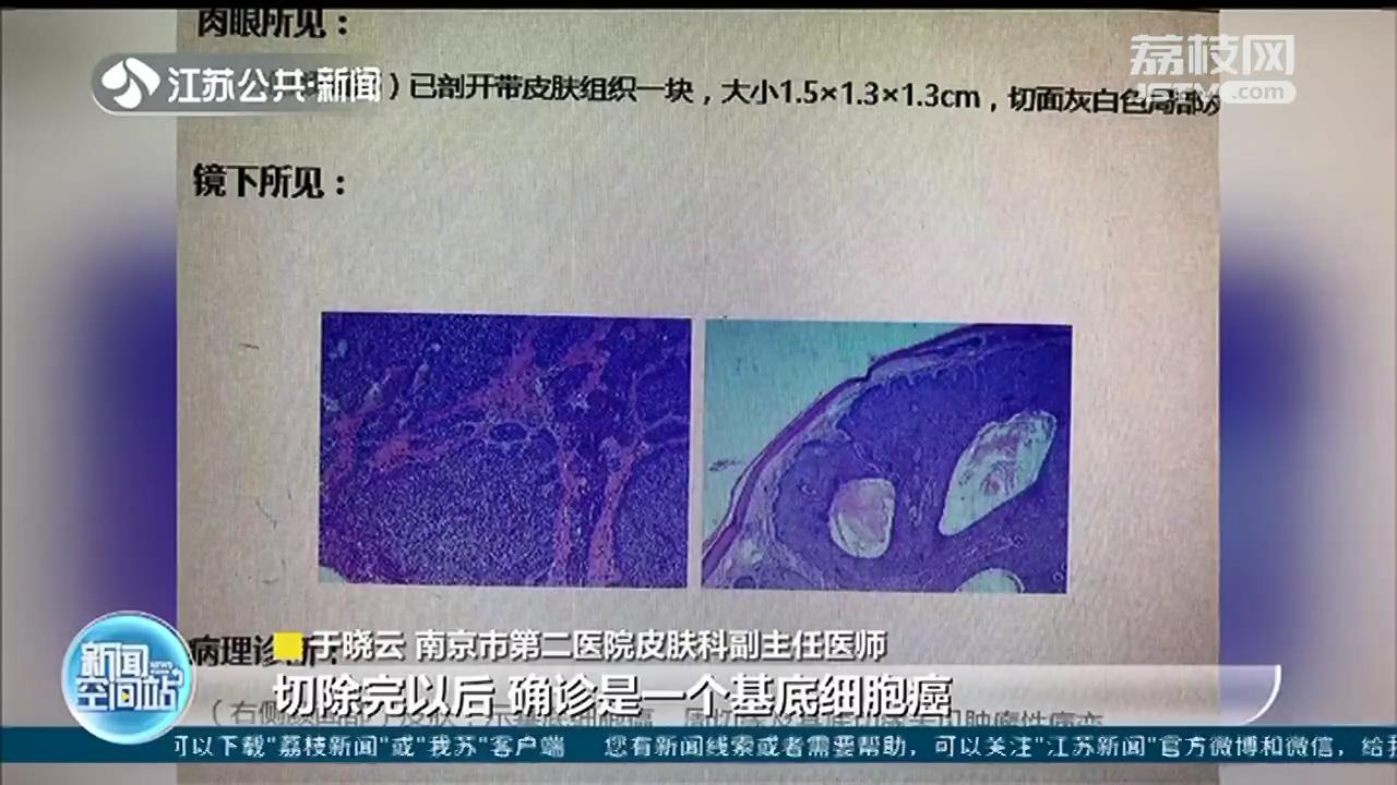 当心！男子脸上痣突然增大 一查竟是基底细胞癌