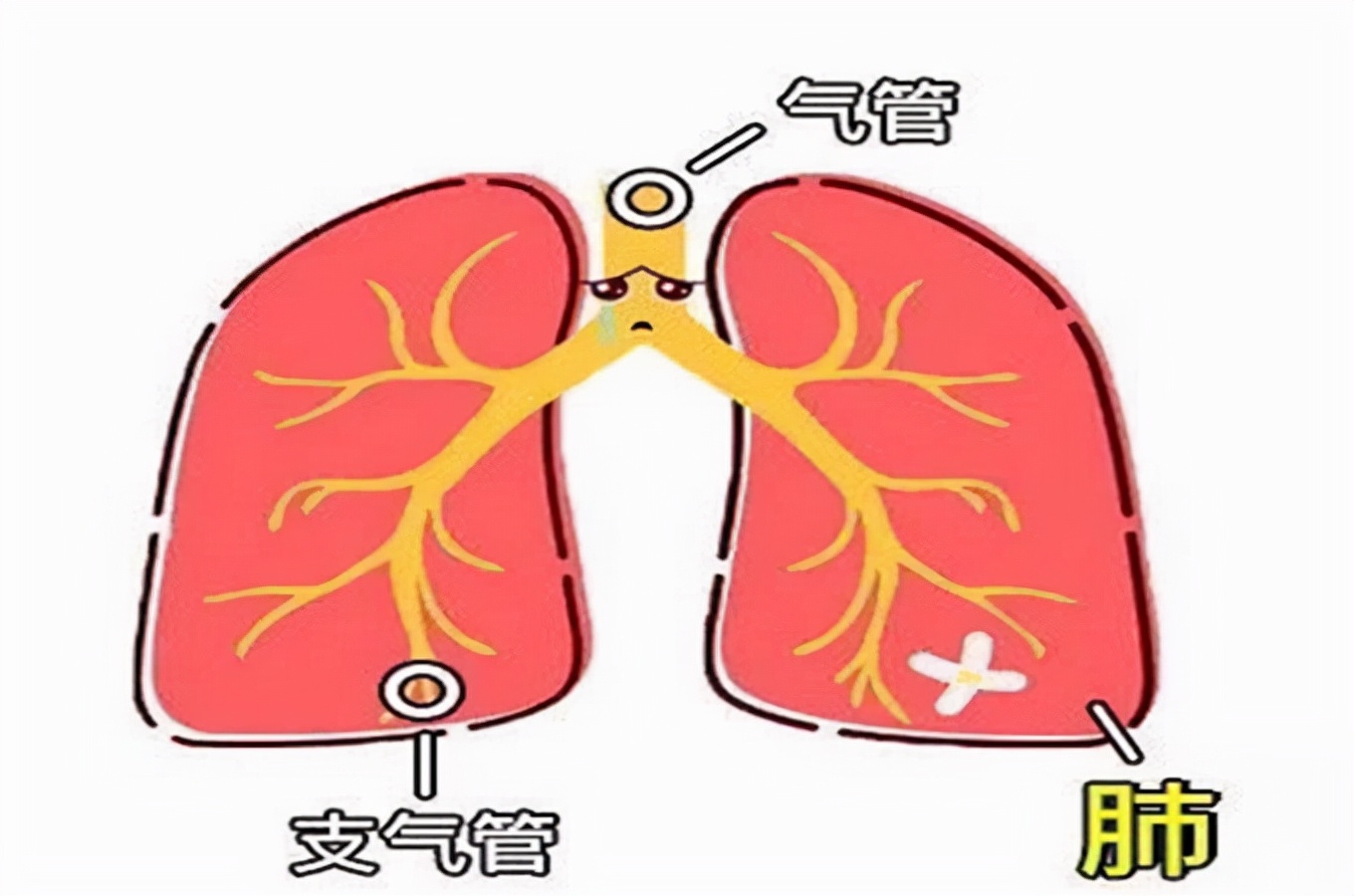 秋冬季节，是支气管炎的“高发期”，支气管炎怎样用药物治疗呢？