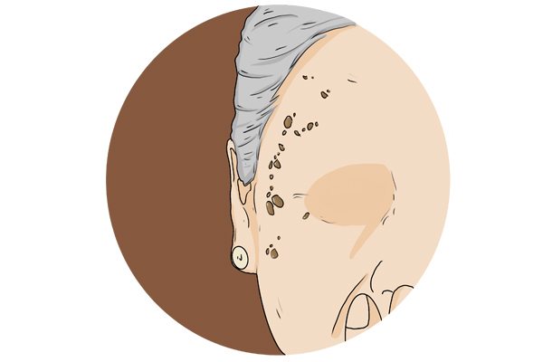 看起来不起眼的痣却有可能癌变？长在3个地方的痣，可能性高