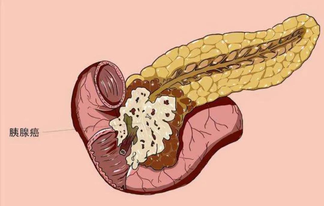 腹痛、消化不良不一定是老胃病，可能胰腺作怪，“癌王”什么特点