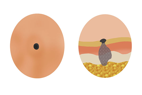 看起来不起眼的痣却有可能癌变？长在3个地方的痣，可能性高