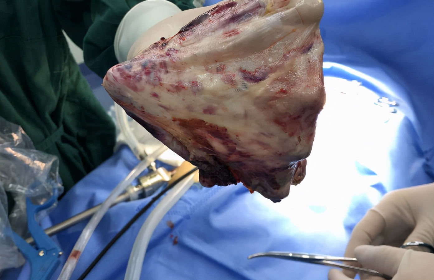 肝上有囊肿严重吗,肝囊肿是肝癌的前兆吗?