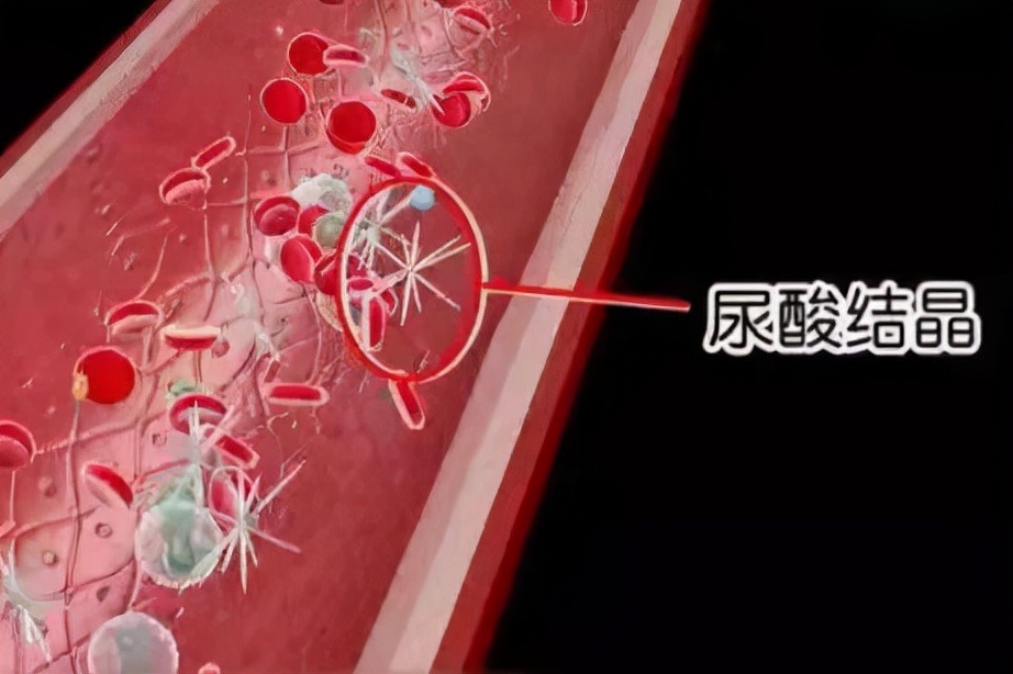 尿酸高不等于痛风，但要警惕并发症，5个方法远离高尿酸