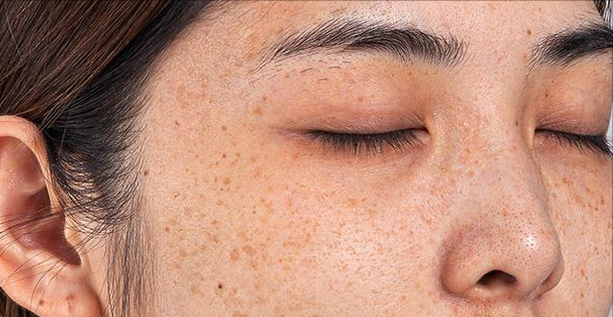 脸上皮肤黄褐斑怎么养比较好「科普」 -骁龙网