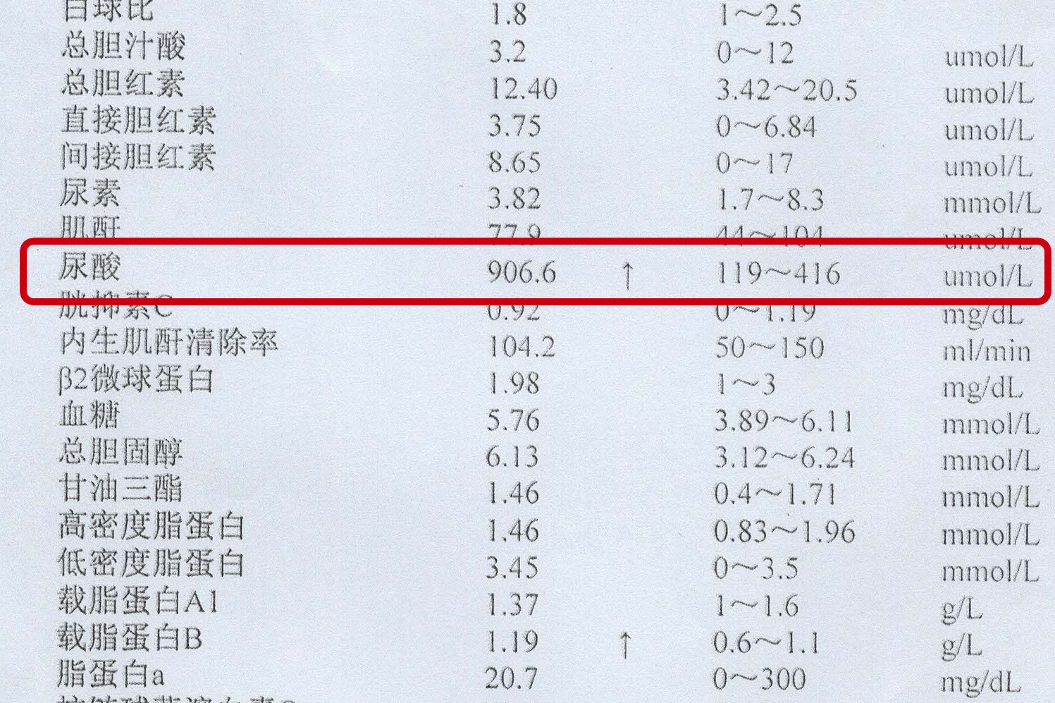 尿酸高不等于痛风，但要警惕并发症，5个方法远离高尿酸