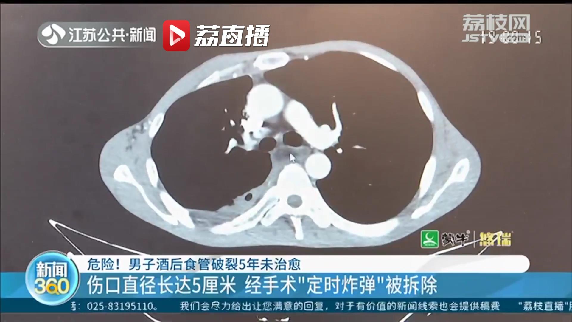 危险！男子酒后食管破裂5年未治愈 犹如&ldquo;定时炸弹&rdquo;