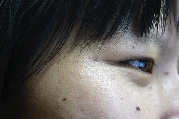 看起来不起眼的痣却有可能癌变？长在3个地方的痣，可能性高