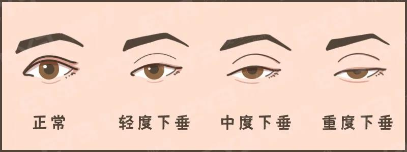 眼睛难以睁开也是一种病？眼科专家：警惕上睑下垂