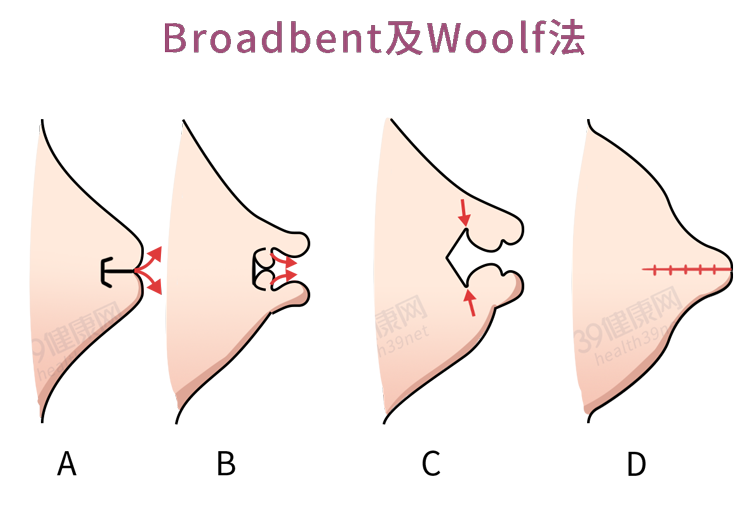 什么是“乳头内陷”？要怎么治疗？2个原因，可能让它暂时消失