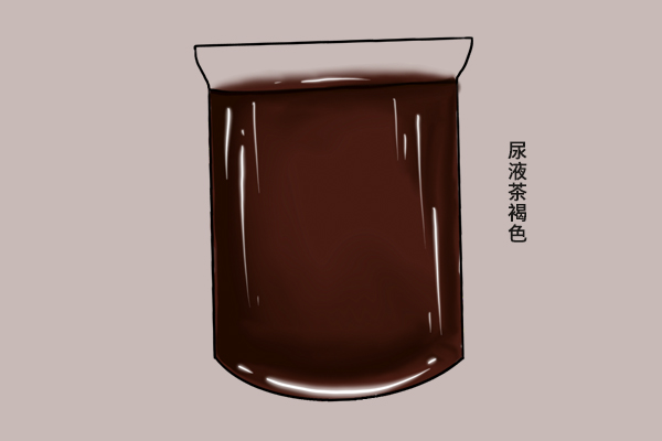 尿液颜色异常，暗示身体有疾？小便后发现6种异样，建议及时检查