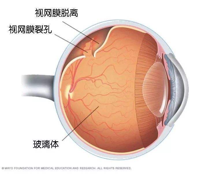 假性近视到什么程度就变成真性近视？假性近视的界定标准是什么？