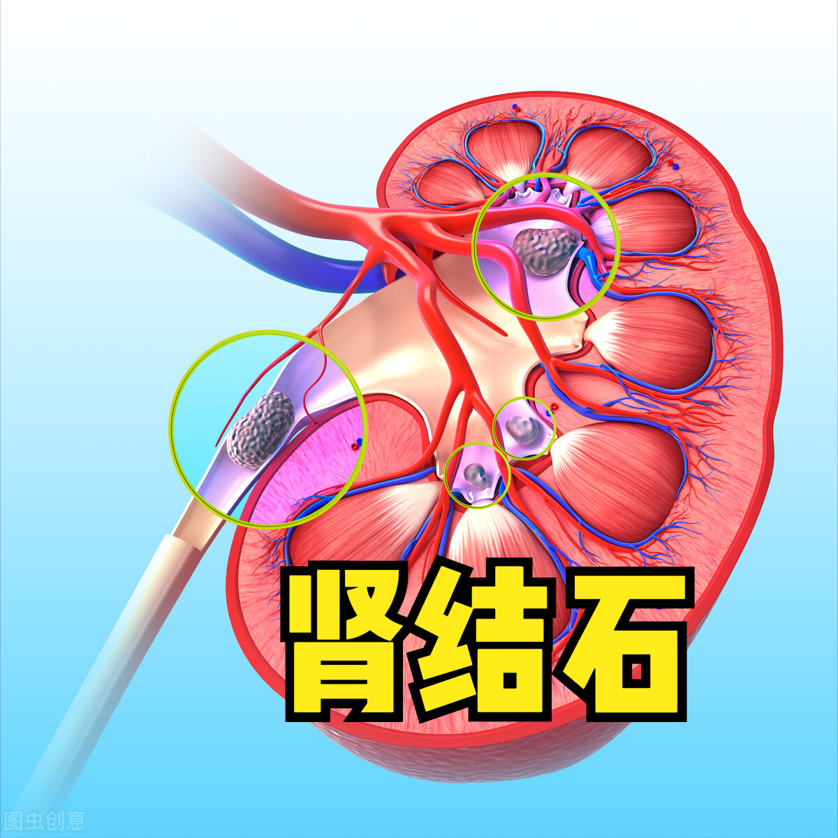 喝可乐能打掉肾结石，是真的吗？辟谣来了，听完年轻人都想戒掉它