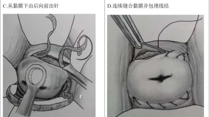 宫腔镜前扩宫插管过程图片