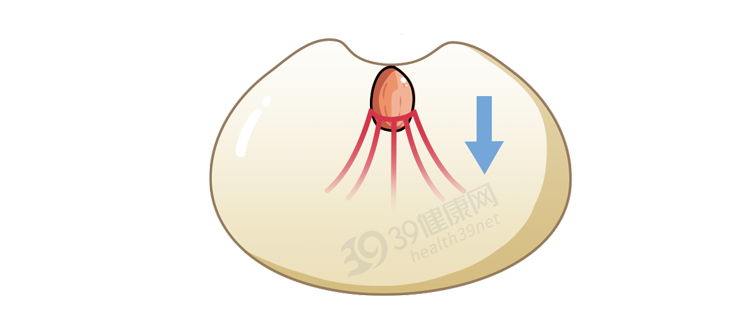 什么是“乳头内陷”？要怎么治疗？2个原因，可能让它暂时消失