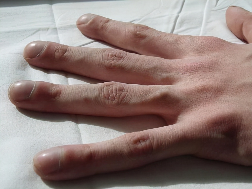 尿酸過高，雙手有什麼變化，如果沒有，說明尿酸還算穩定