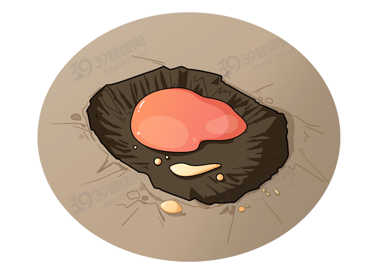 什么是“乳头内陷”？要怎么治疗？2个原因，可能让它暂时消失