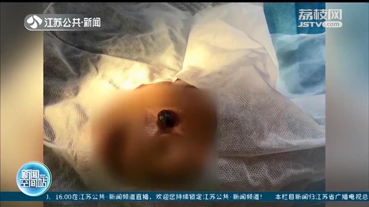 当心！男子脸上痣突然增大 一查竟是基底细胞癌