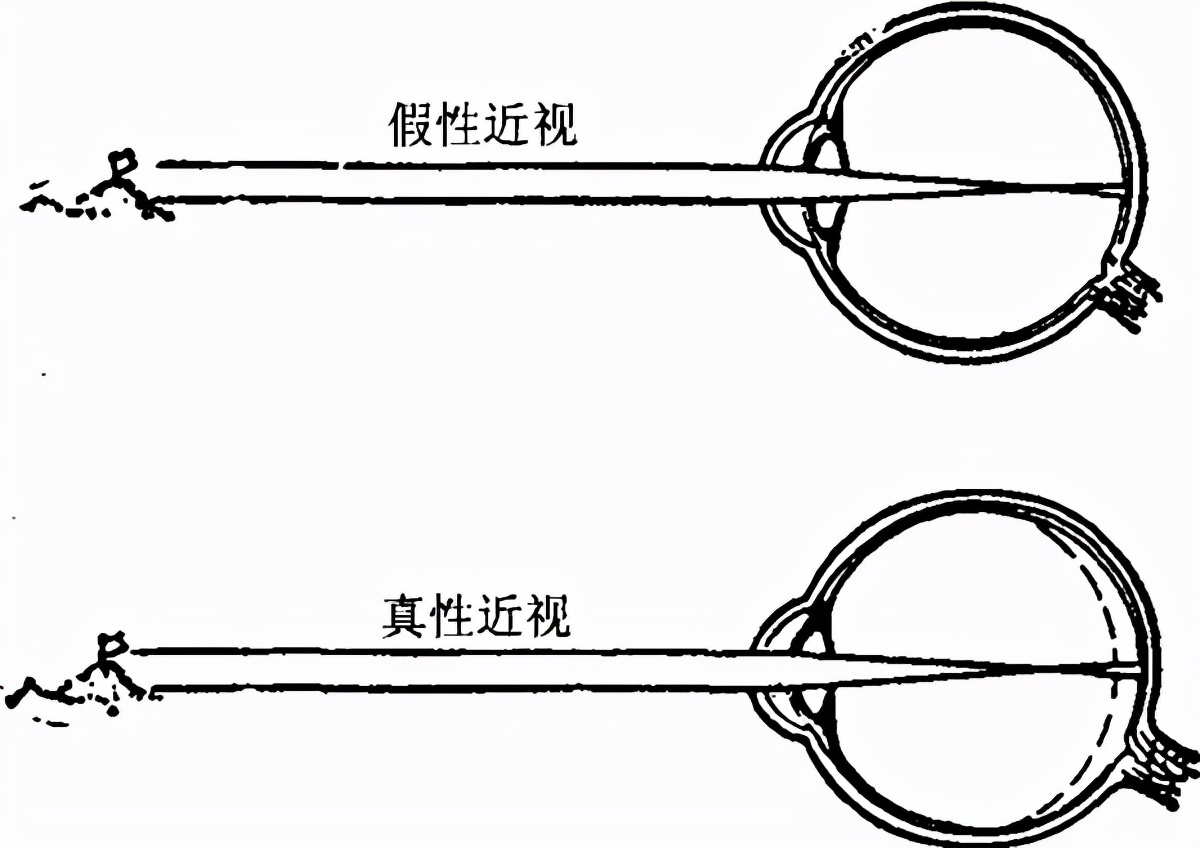 假性近视到什么程度就变成真性近视？假性近视的界定标准是什么？