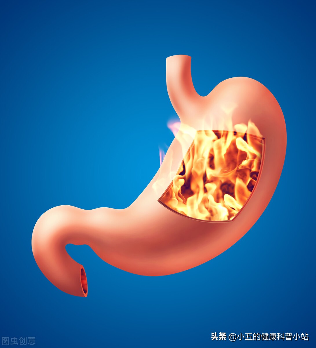 得了慢性萎縮性胃炎不可怕，科學使用4類藥物，積極預防病情發展