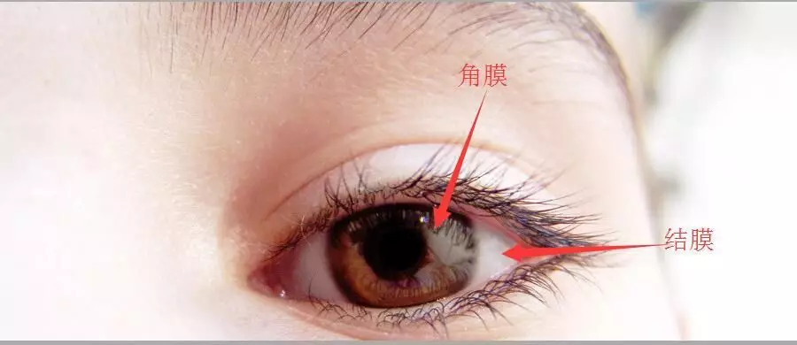 怕光、流泪、眼疼......26岁女生眼肿成“金鱼”!严重可致盲