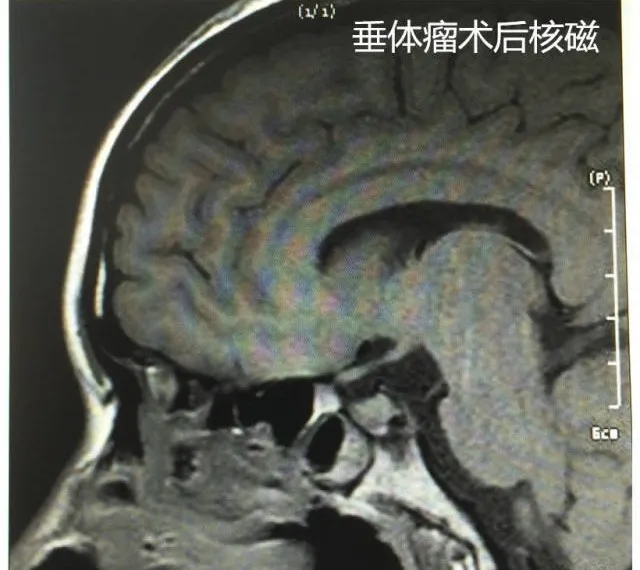 脑肿瘤也可能导致不孕不育插图2 脑肿瘤也可能导致不孕不育