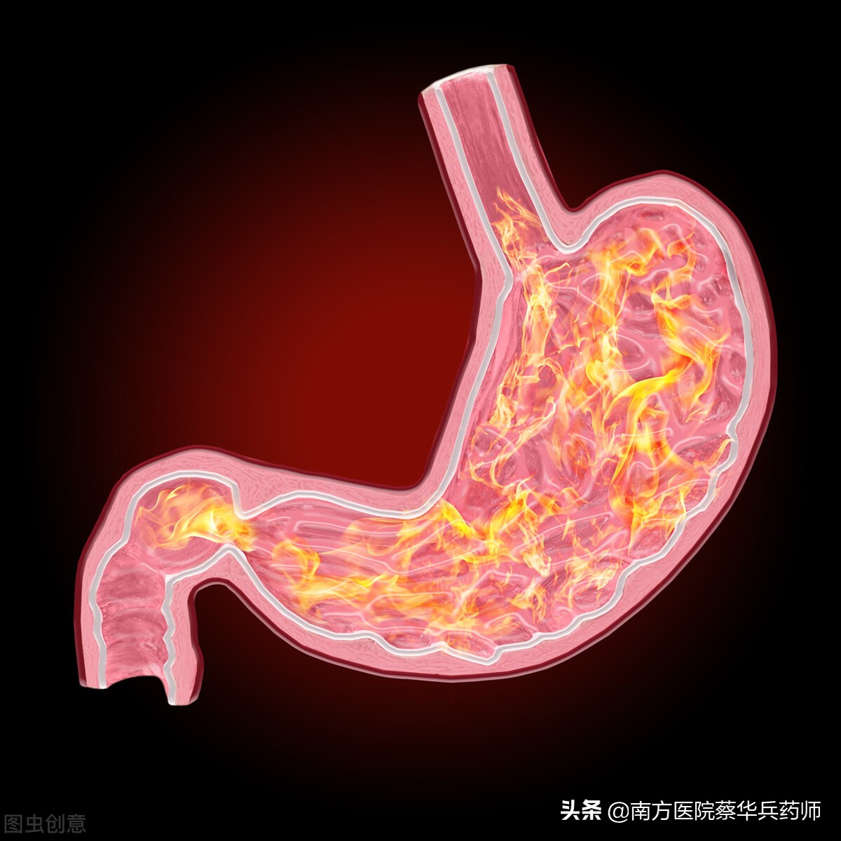 治胃病方子（反酸烧心篇）