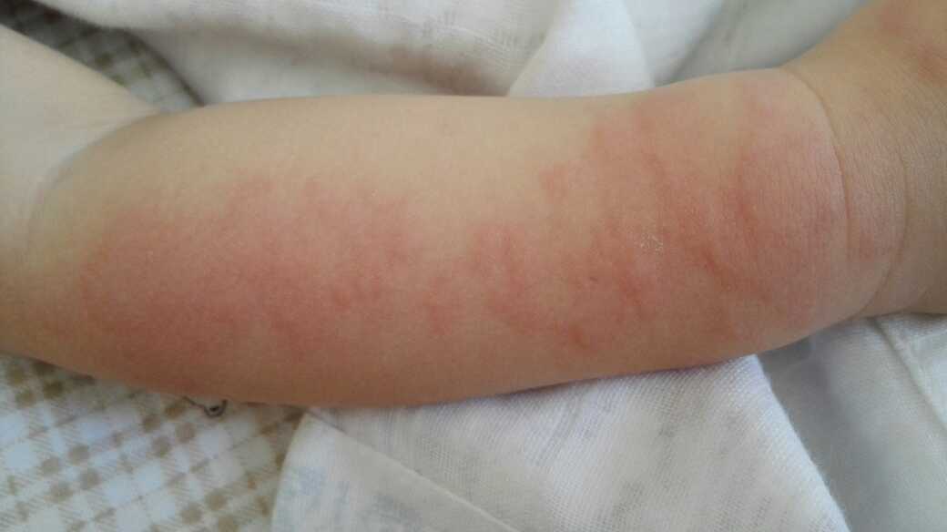 如果要给孩子吃鱼的话,可以吃一些不容易过敏的,比如说三文鱼,鳕鱼这