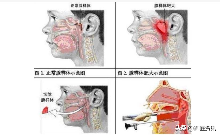 腺样体肥大是个什么病？是怎么毁掉我们的容貌的呢？如何去治疗呢