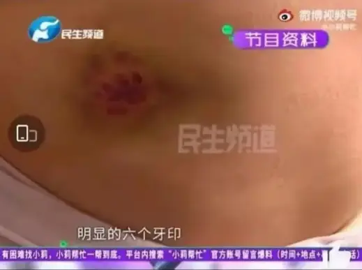 狗咬人事件气哭记者 狗主人被停职（登门道歉了）