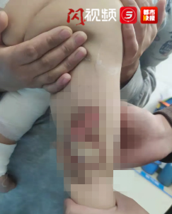 西安1岁男童尿湿电热毯被烧伤，警惕这些取暖神器