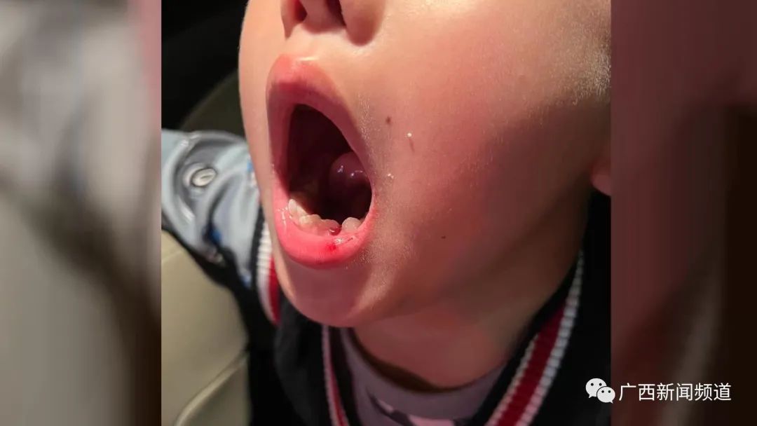 南宁6岁男童被钢琴老师扇掉一颗牙，老师：正常教学而已
