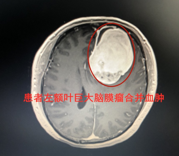 莫名头痛头晕，小心脑瘤卒中发作